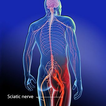 sciatica Newmarket e1588087984844