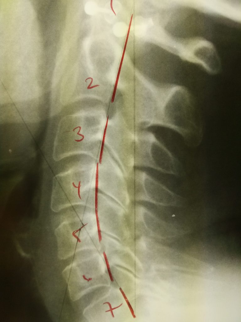 neck x ray newmarket chiropractor e1491401196798