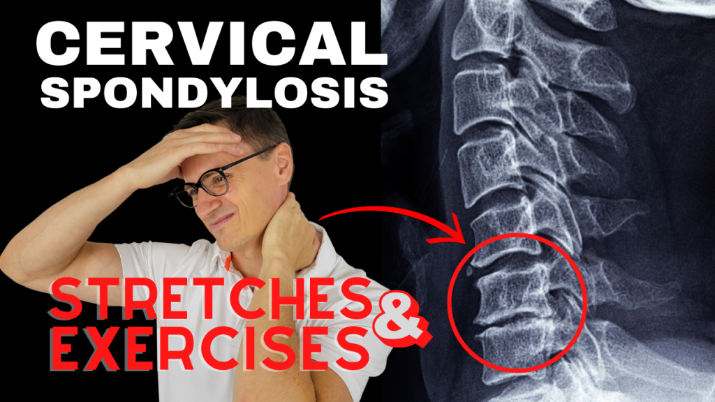 cervical spondylosis e1667591422769