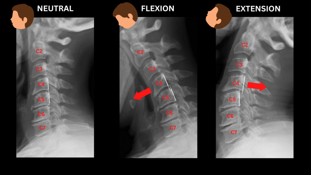 xray cervical instability1