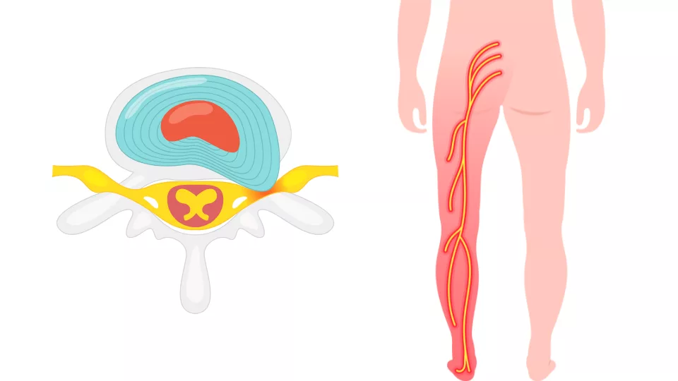 Lumbar spine diagram showing irritated sciatic nerve root